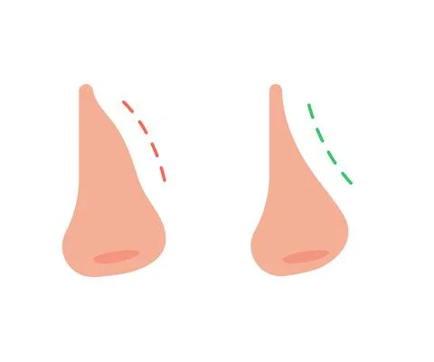 Correction of profile of nose line, changing nasal shape during rhinoplasty s Stock Illustration