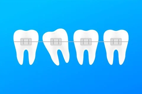 Correction of teeth with orthodontic braces. Stages of teeth alignment. Denta Stock Illustration
