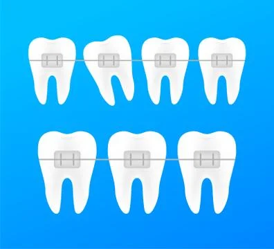 Correction of teeth with orthodontic braces. Stages of teeth alignment. Denta Stockillustratie