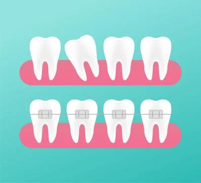 Correction of teeth with orthodontic braces. Stages of teeth alignment. Denta Stockillustratie
