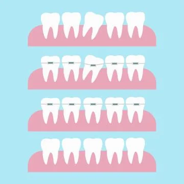 Correction of teeth with orthodontic braces. Tooth orthodontic treatment. Before Stock Illustration