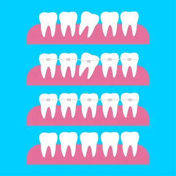 Correction of teeth with orthodontic braces. Tooth orthodontic treatment. Before Stock Illustration
