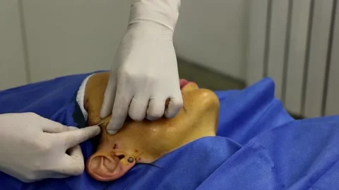 Correction of thread face lifting using absorbable threads. Close-up Stock Footage 166000479