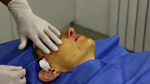 Correction of thread face lifting using absorbable threads. Close-up Stock Footage 166000540