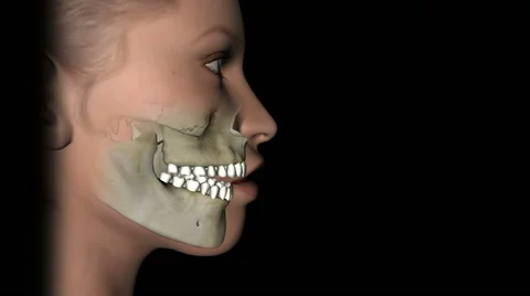 Corrective jaw surgery for open bite 스톡 동영상 46029347
