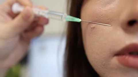 Cosmetic acne injection procedure Video stock 335172472