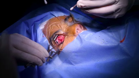 Cosmetic eye surgery Video stock 146288768