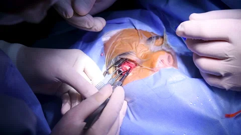 Cosmetic eye surgery Stock Footage 146288955