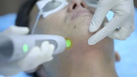 Cosmetic Laser Procedure Close Up 動画素材 97865544