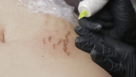 Cosmetic practitioner performs plasma pen treatment on facial skin, Close view 库存影片 340034501