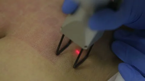 Cosmetic procedures to remove stretch marks Video stock 57895771