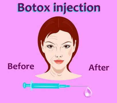 Cosmetic surgery vector illustration. Botox injection. facial wrinkle treatment. Stock Illustration