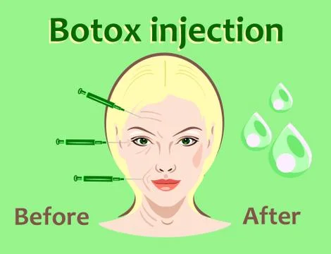 Cosmetic surgery vector illustration. Botox injection. women facial wrinkle Stock Illustration