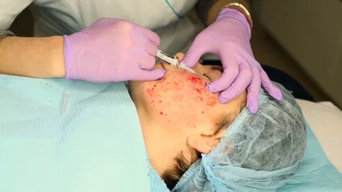 Cosmetician using needle while doing shots of botox to her client's face Stock Footage 76187173