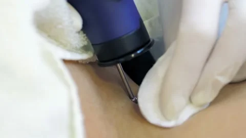 Cosmetologist dermatologist performs hardware laser hair removal to a patient in Stock Footage 169519385