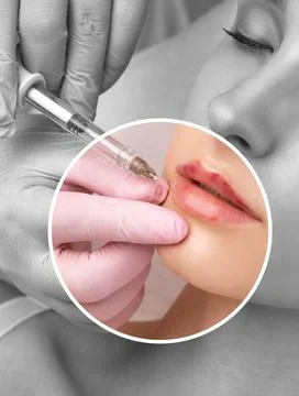 Cosmetologist does injections for lips augmentation anti wrinkle injections.. Stock Photos