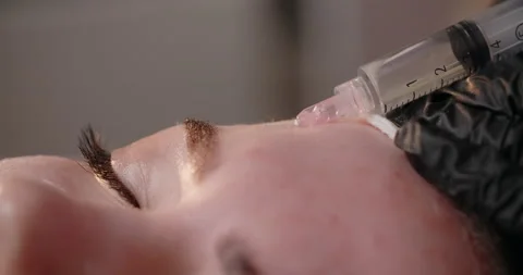Cosmetologist does injections to the woman's face, botox and hyaluronic acid Stock Footage 170703142