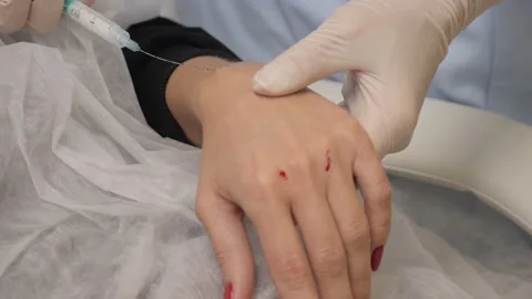 The cosmetologist inserts an injection into the palm of the patient. Vídeo Stock 147071052