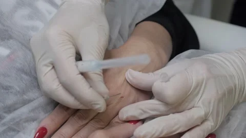 The cosmetologist inserts an injection into the palm of the patient. Vídeo Stock 147142482