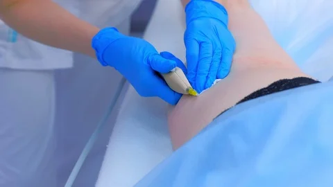 Cosmetologist making injection carbon dioxide on patient leg on carboxytherapy. Stock Footage 129614895
