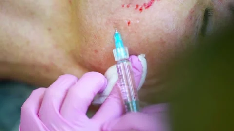 The cosmetologist performs an injection into the eye area with maximum accuracy, Vídeo Stock 289437697