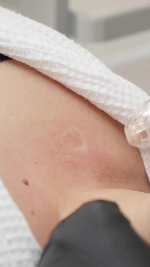 Cosmetologist performs RF lifting procedure Stock Footage 268113051