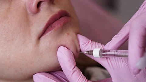 The cosmetologist performs several injections in the chin. Chin Injection Video stock 201873236