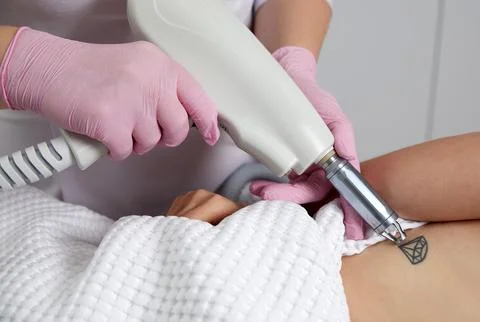 Cosmetologist using laser device to remove an unwanted tattoo from female arm Stock Photos