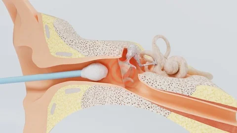 Cotton swab tears the eardrum Stock Footage 80636672