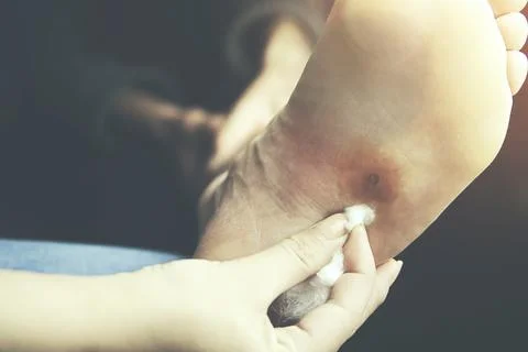 Cotton  on wound Stock Photos