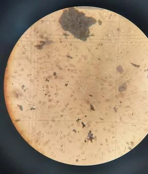 Counting erythrocytes using a hemocytometer. Foto stock