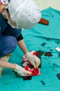 The counting process is done after all the surgeries. Stock Photos