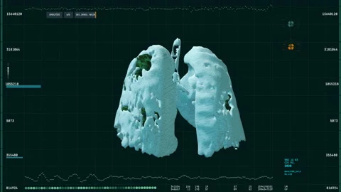 Covid 19. Computer user interface, creation three-dimensional model of the lungs Stock Footage 148782715