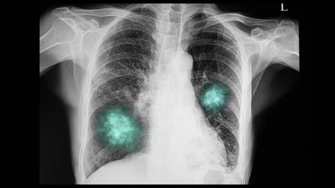 Covid-19 pneumonia simulation Stock Footage 160358722