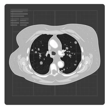Covid-19 Testing - Human Lungs X-Ray - Illustration Stock Illustration