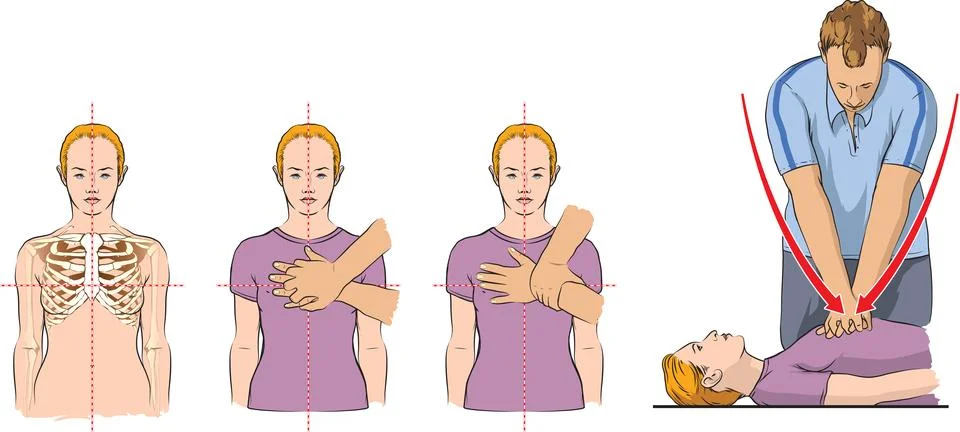CPR procedure Stock Illustration