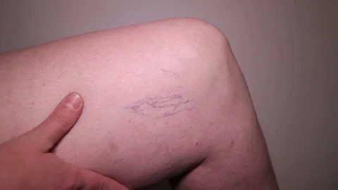 Cracked Capillaries On The Leg Stock Footage 71643008