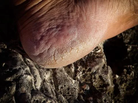 Cracked heel Stock Photos