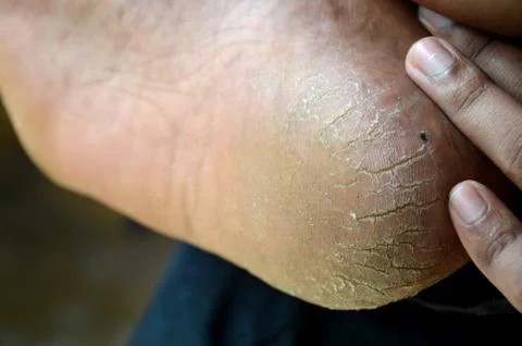 Cracked heels Stock Photos