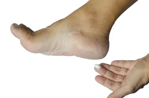 Cracked heels Stock Photos