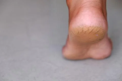 Cracked Heels Stock Photos