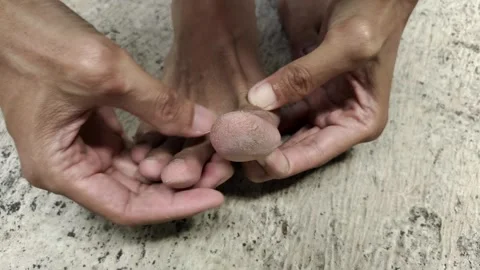 Cracked Toe Skin Stock Footage 318576490