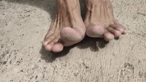 Cracked Toe Skin Stock Footage 318576496