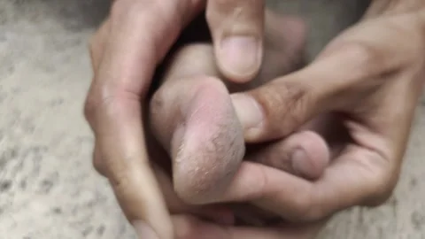 Cracked Toe Skin Stock Footage 318576497
