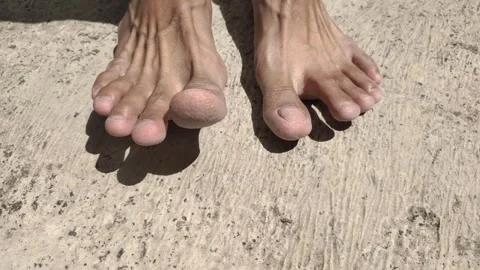 Cracked Toe Skin Stock Footage 318576551