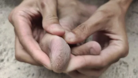 Cracked Toe Skin Stock Footage 318576557