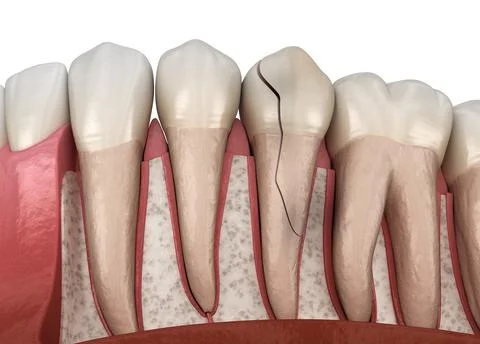 Cracked tooth, splitted. Medically accurate 3D illustration Stock Illustration