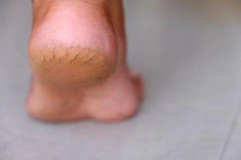 Cracks on Heels Stock Photos