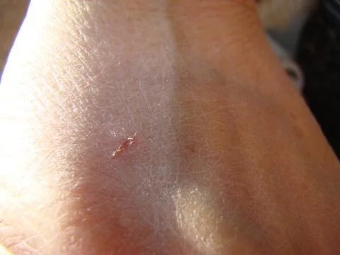 Cracks in the skin Stock Photos