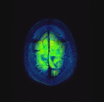 Cranial MRI Stock-Footage 64799541